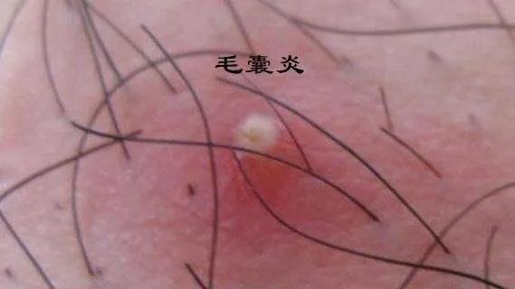 扁平疣和黑色素痣区别,疣与色素痣的区别