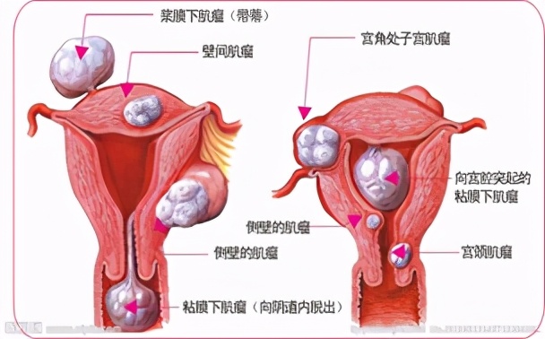 子宫肌瘤切不切有什么影响,切子宫肌瘤和切卵巢哪个伤害大