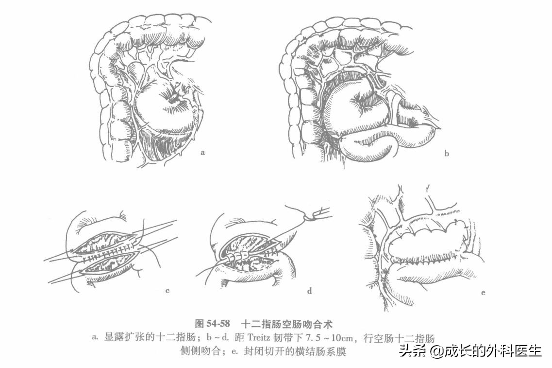 肠系膜上动脉压迫综合征ct表现,儿童肠系膜压迫综合征哪种手术好
