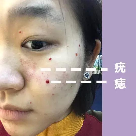 激光祛痣怎么好得快不留疤,激光祛痣亲身经历和感受