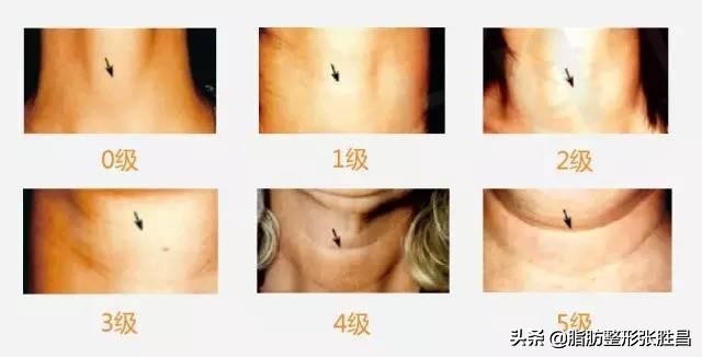 颈纹太多又显老，但常规方法祛除总是不能持久？做这个就可以了