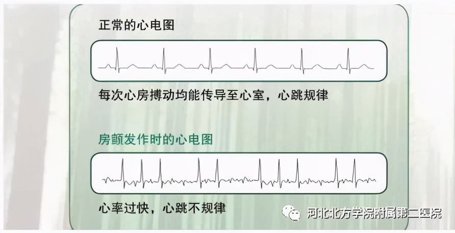 一例罹患多种心律失常病人在宣化二附医院成功实施射频消融术