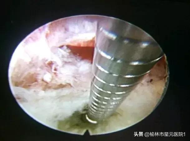 榆林佳县治疗腰椎间盘突出,榆林腰椎间盘突出最有效治疗