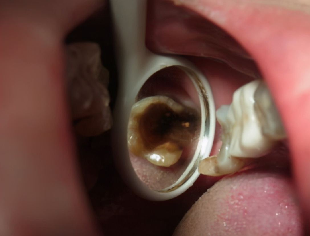 种植牙手术怎么操作,种植牙手术全过程是什么样的