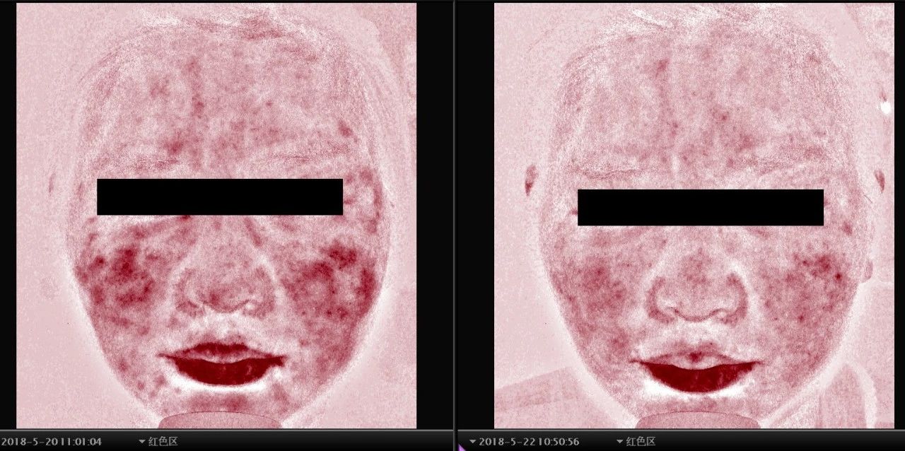 皮肤科激素依赖性皮炎,皮肤科名医激素依赖性皮炎