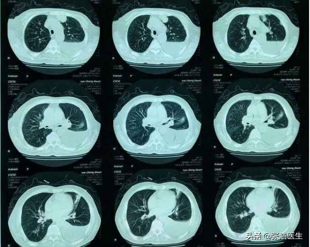 突发胸闷感觉喘不过气是怎么回事,呼吸困难咳嗽胸闷气短是肺炎吗