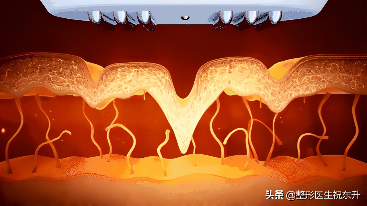 超声刀和热玛吉有必要都做吗,超声炮热玛吉热拉提哪个效果好