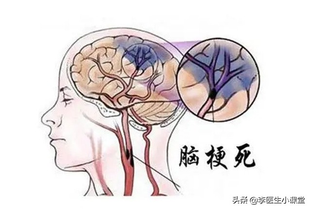 老年人补充叶酸预防脑梗有讲究,老人吃叶酸防脑梗有讲究