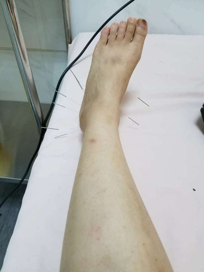 痹症用针灸治疗是缓解还是根治,痹症针灸哪些穴位