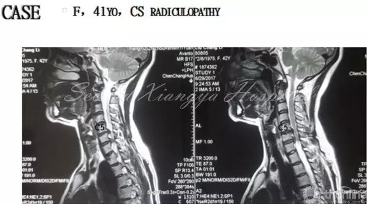 经皮腰椎间盘切除术有何优缺点,什么是经皮内镜腰椎手术