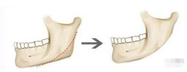 那些削骨的女明星怎么样了,哪些明星承认削骨了