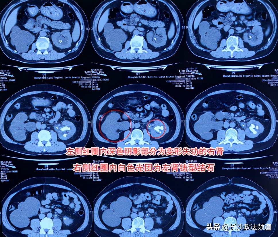 右肾萎缩有结石血尿,男子医院肾结石意外发现三个肾