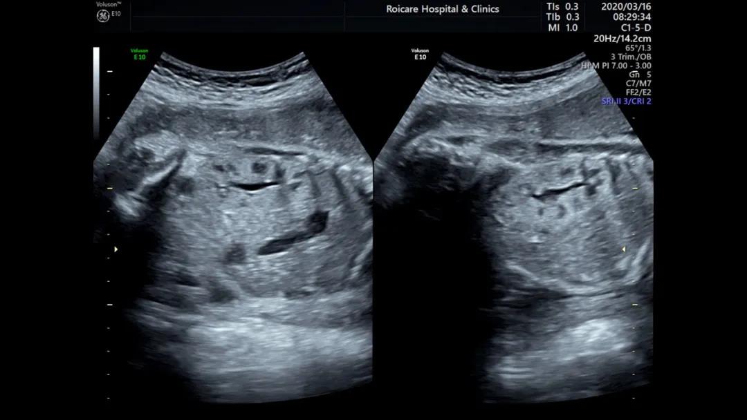 胎儿超声强回声,胎儿超声超细讲解视频