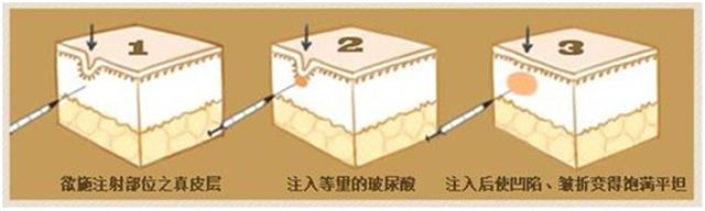 面部线雕跟超声刀哪个好,超声刀线雕和拉皮哪个效果好