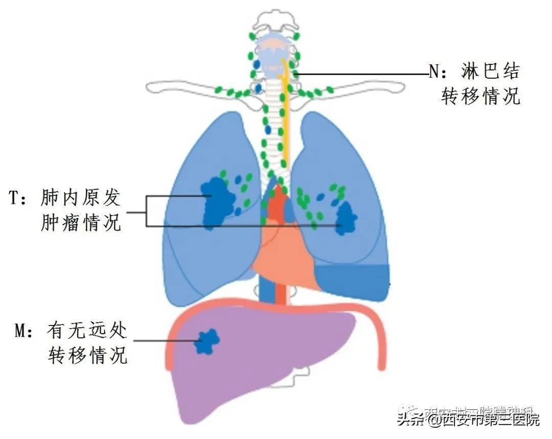 患者讲述肺癌症状,中医讲解肺癌早期的症状