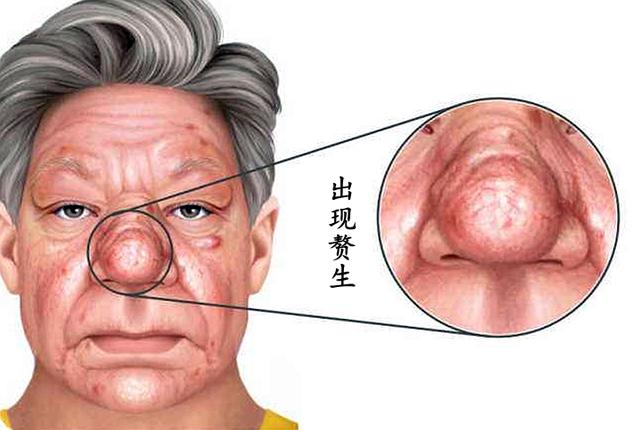 玫瑰痤疮反复发作怎么治疗,痤疮常见皮损不包括