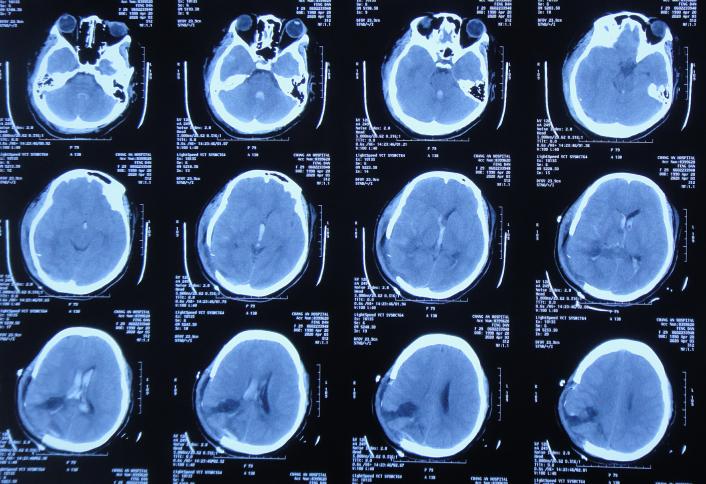 脑室有粘连脑积水有什么办法,脑动脉畸形手术后出现急性脑积水