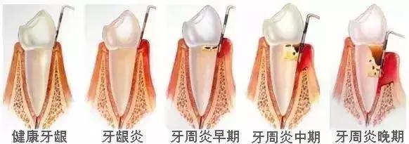 Helen齿科中心——你了解牙龈炎吗？