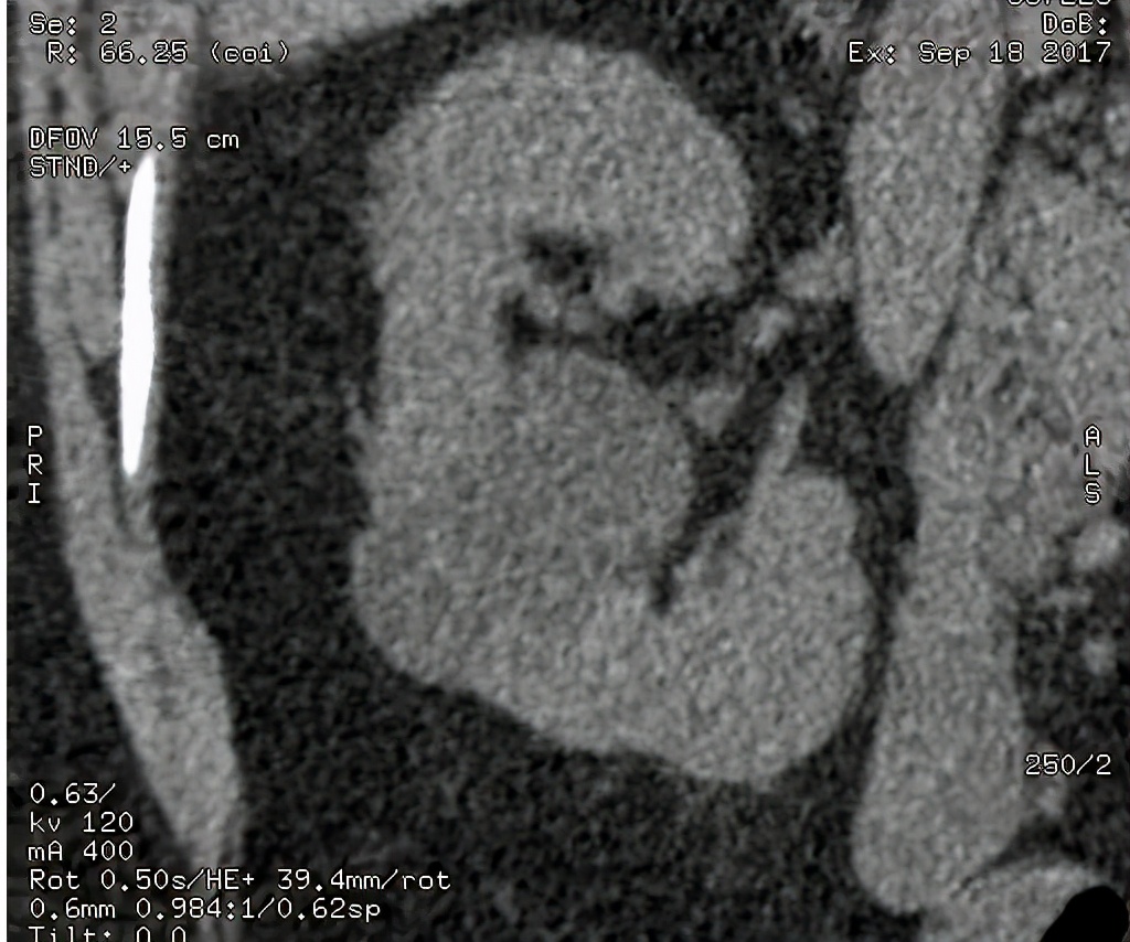 尿路造影输尿管间断显影,静脉尿路造影和排泄性尿路造影