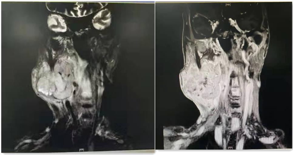 良性腮腺肿瘤术后注意事项,腮腺肿瘤切除后注意事项