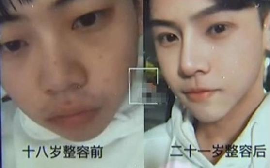 整容成功的真实案例,5万整容成功逆袭案例