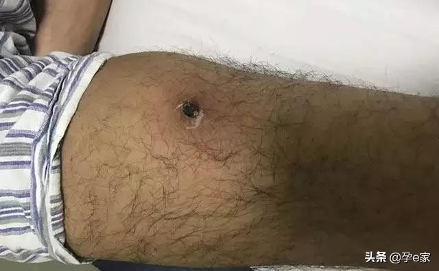 身上出现许多小黑痣,身上出现凸起黑痣一定要重视