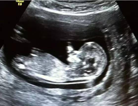 怀孕后需要查什么,怀孕之后查什么