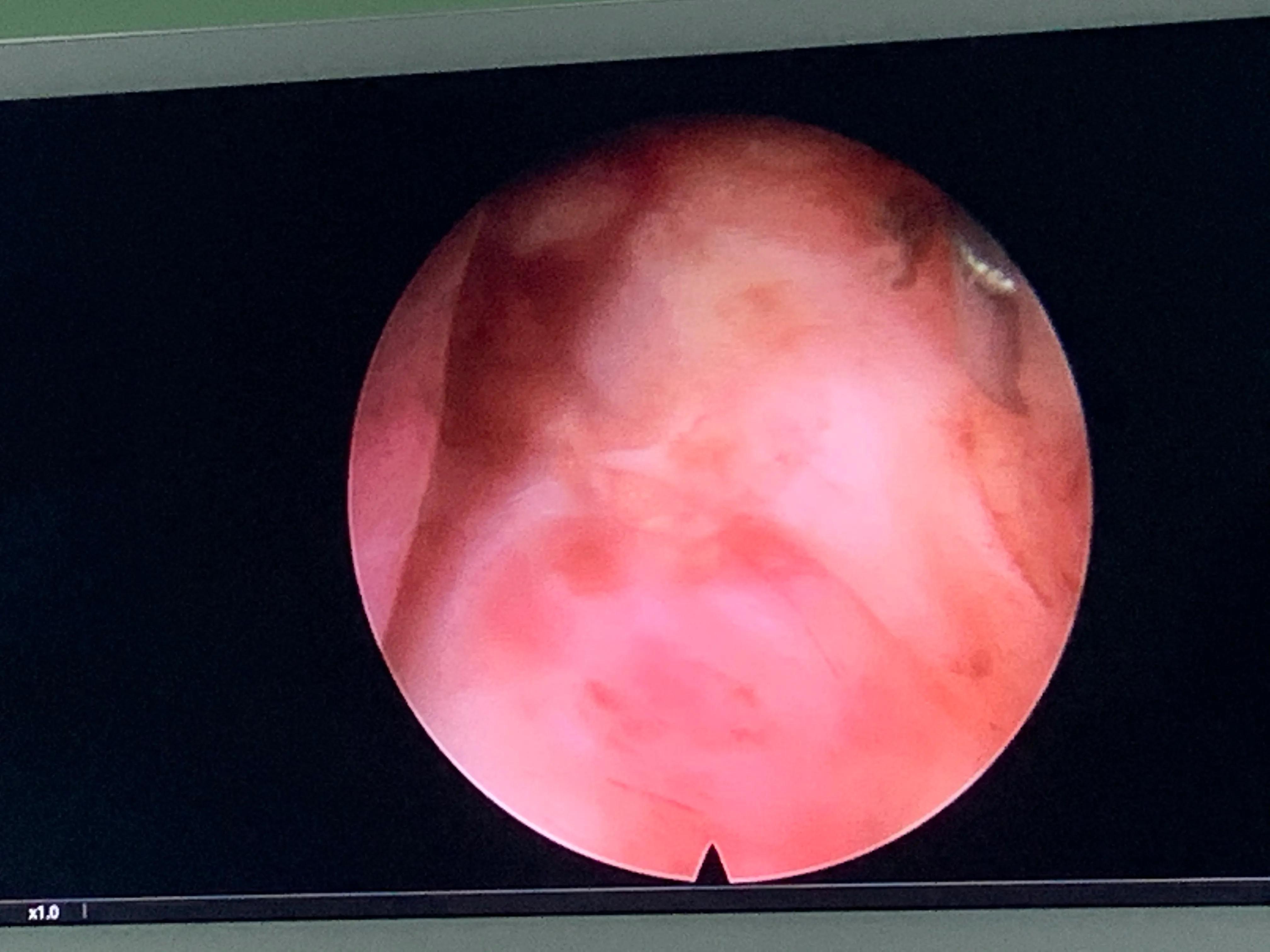 椎间孔镜术后腰痛症状多久消失,盘源性腰痛手术后易复发吗