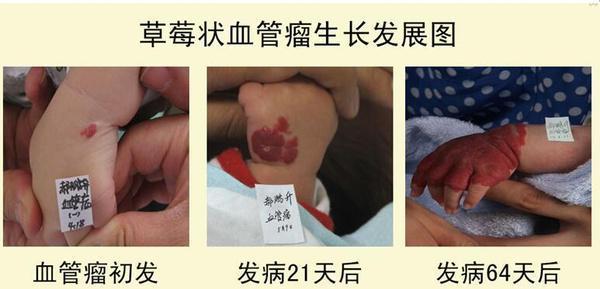 一个月宝宝得了血管瘤怎么办,宝宝身上有血管瘤怎么办