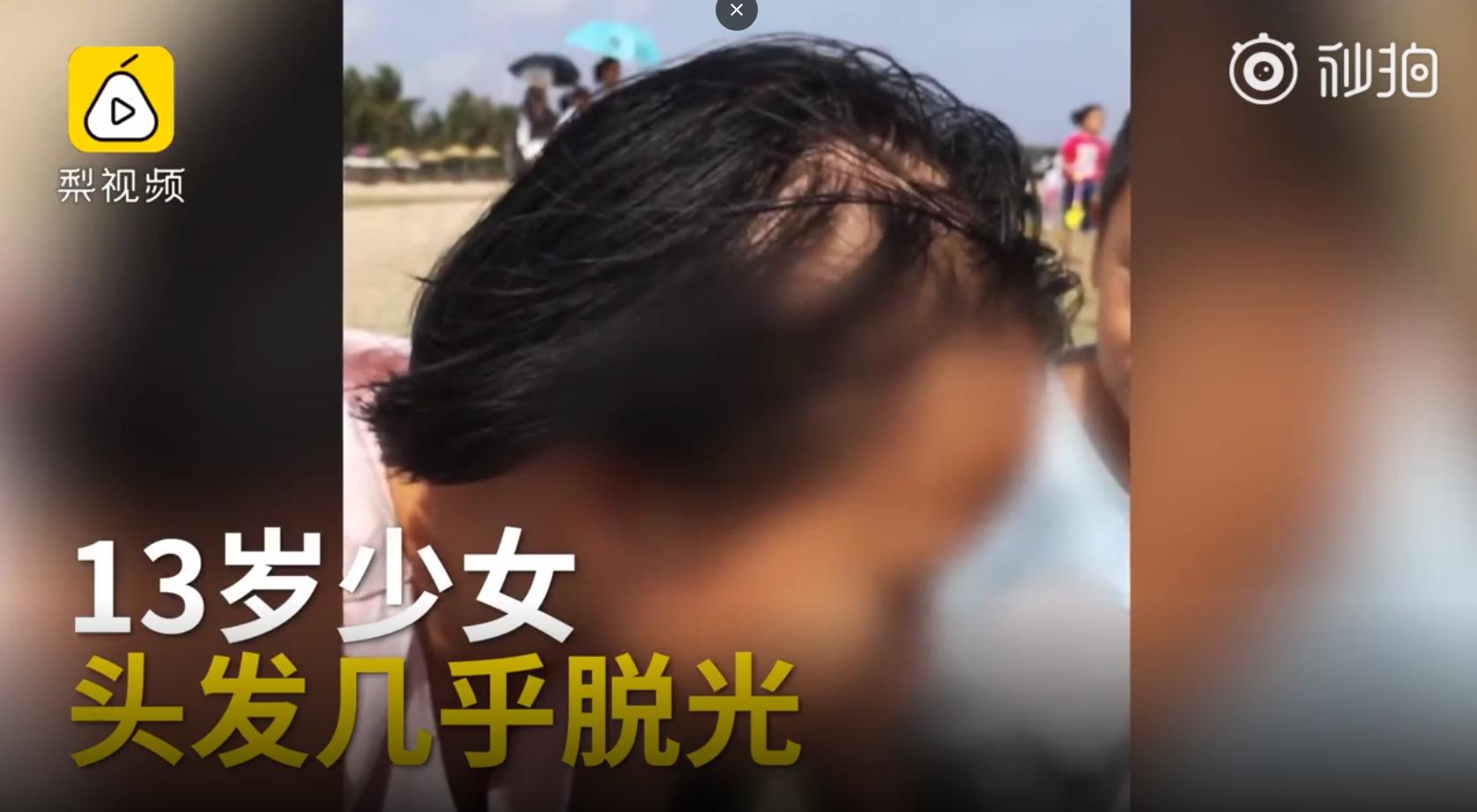 解救秃头少女防脱发的好方法,青少年脱发的原因和治疗方法