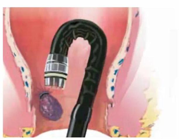 做肠镜喝泻药痔疮出来了怎么办,肠镜检查发现有痔疮可以切掉吗