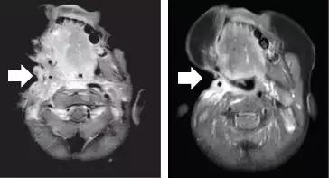70种抗癌药新特效药,十大抗癌新药治疗癌症