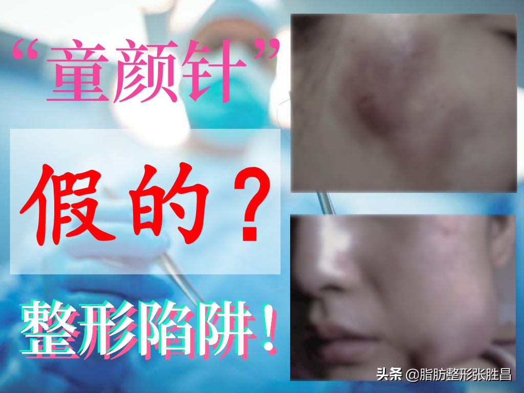 为什么美容医院会给你推荐童颜针,打童颜针危险