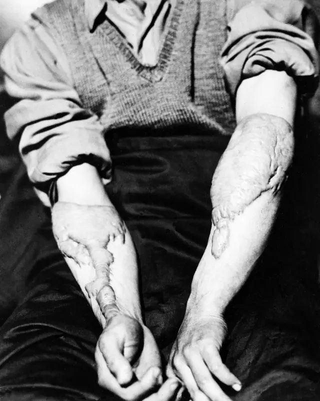 1900年，欧洲人用X光试鞋、脱毛甚至选美，使用者最后怎么样了？