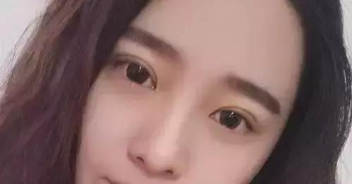男生割内双眼皮手术,男子去割单眼皮后的结果