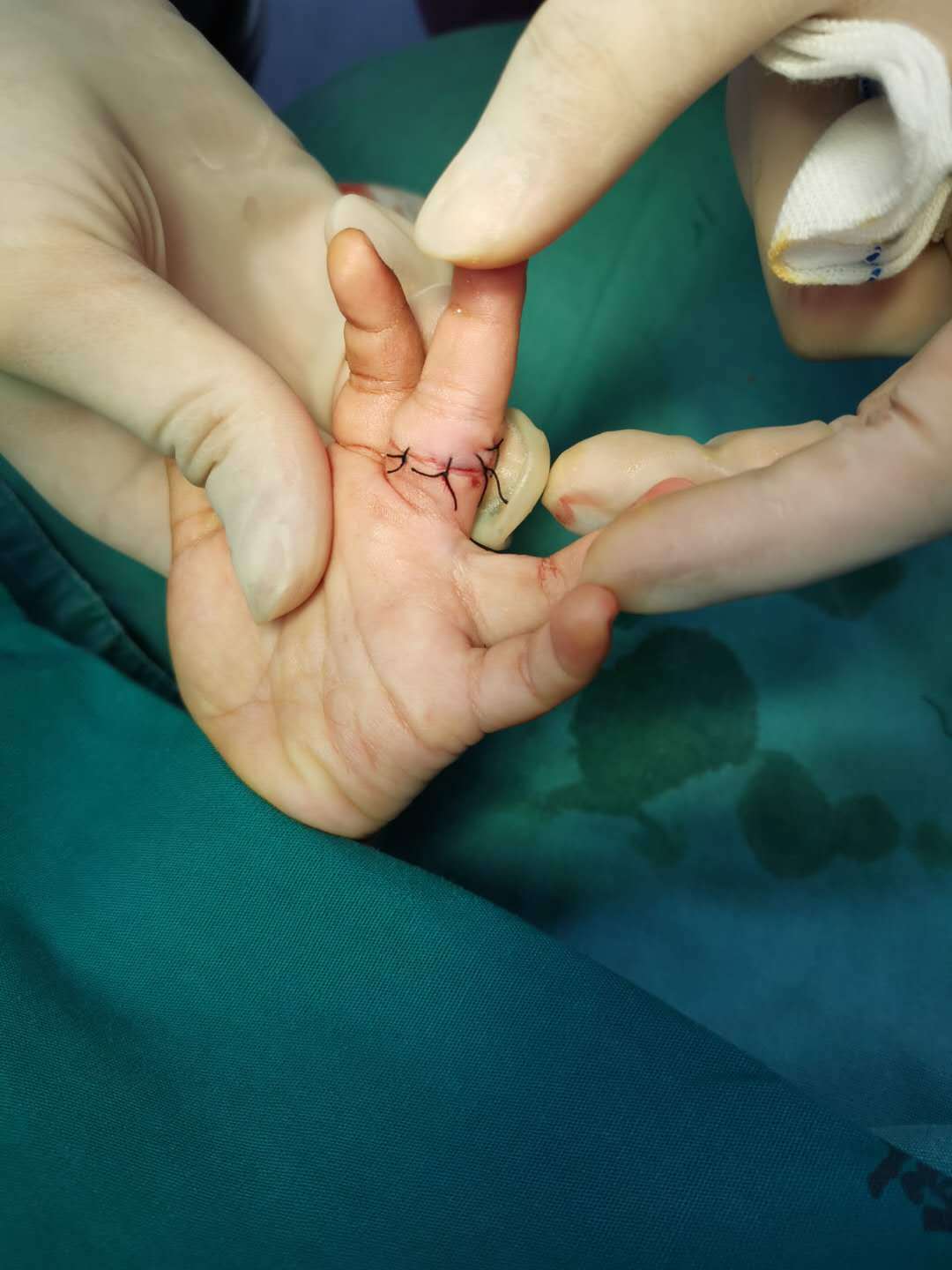 银戒指儿童,银戒指治宝宝惊吓