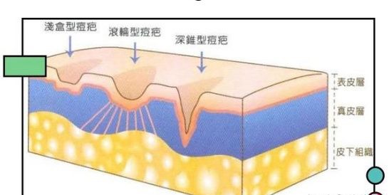 脸上痘印多久会自行消失,在脸上挤痘痘留下的痘印会消失吗