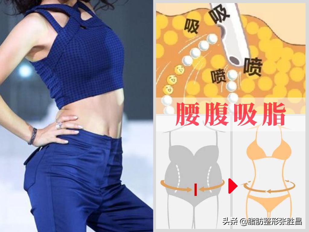 做过腹部整形的来说说,做过吸脂的有后悔的吗