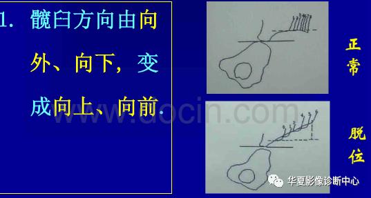 先天性髋关节脱位饮食,先天性髋关节脱位属不属于残疾人