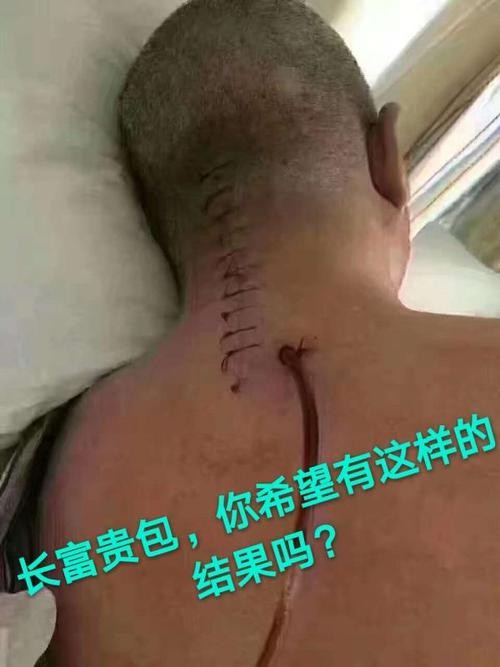 负压吸脂和射频吸脂,光纤溶脂和负压吸脂优缺点