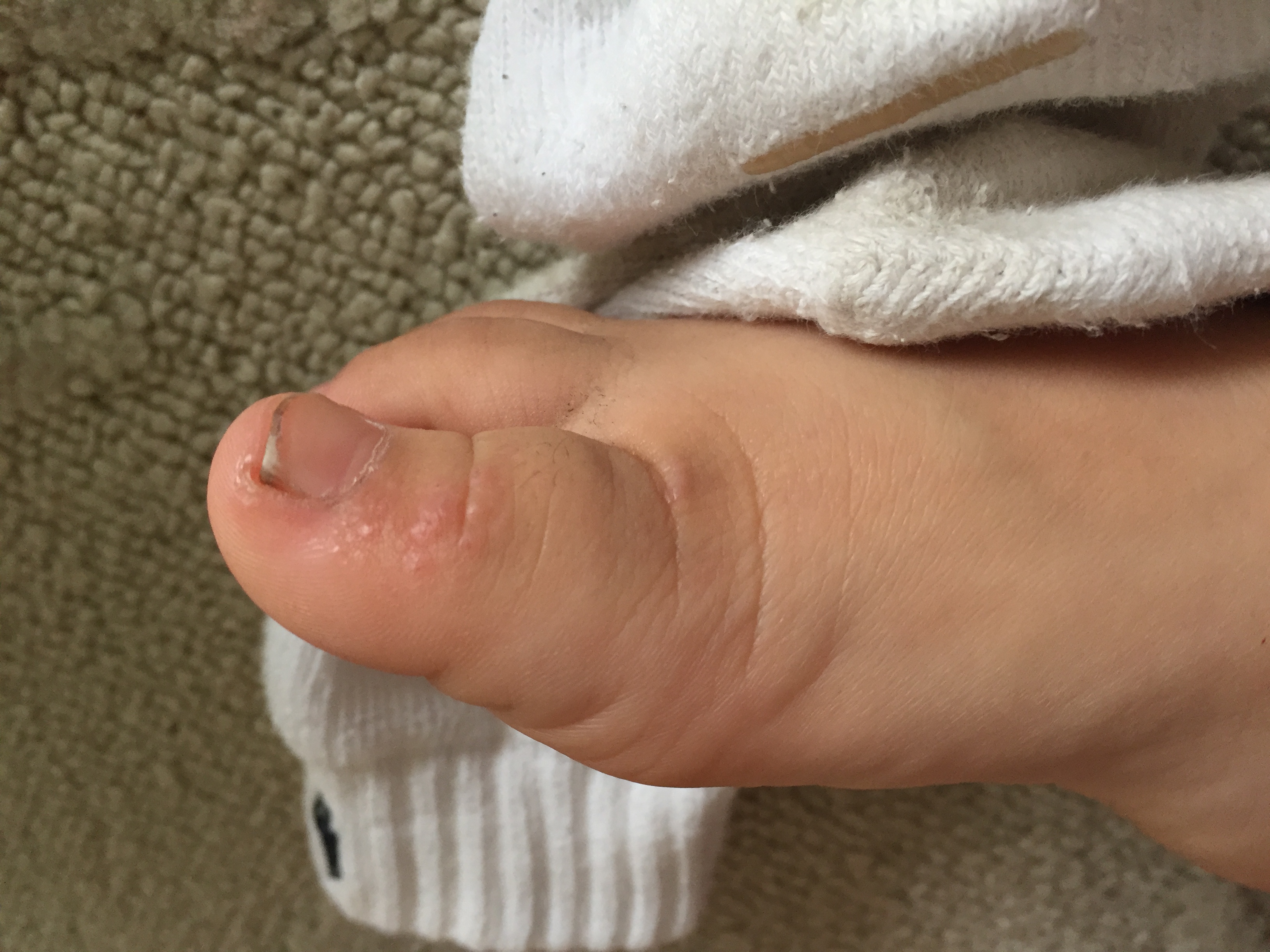 皮肌炎或多发性肌炎的诊断标准,成人皮肌炎与儿童皮肌炎区别