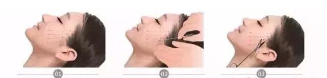 线雕是面部提升最好的方法吗,面部提升最好的方法是线雕吗