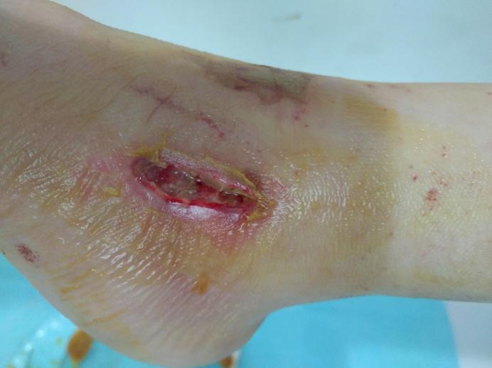 术后伤口要每天换药吗,术后伤口拆线还需要敷纱布吗