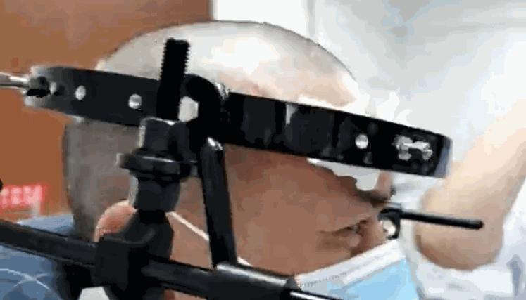 逃过了医院手术的一劫,halovest支架