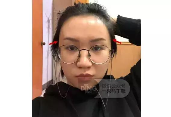 颅顶太低如何自救,颅顶低怎么自救