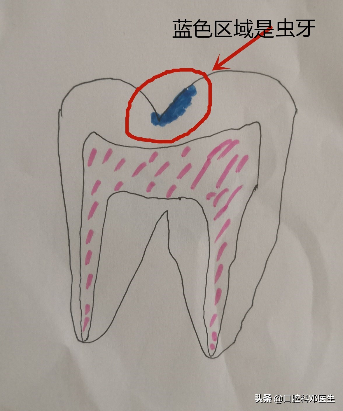 虫牙补牙方法有几种,虫洞露牙补牙的正确方法