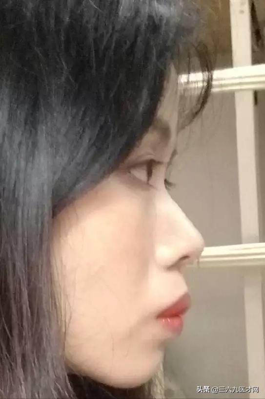 龅牙矫正成功的图片对比,2周岁龅牙可以矫正吗