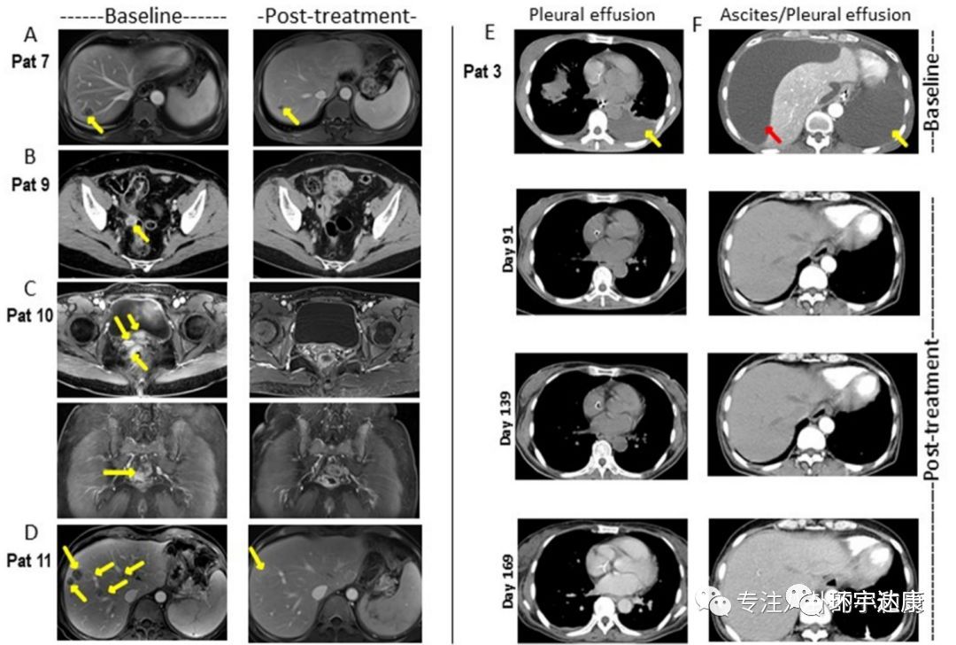 nkt免疫细胞治疗癌症,抗癌细胞疗法