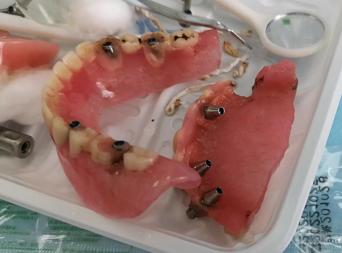 种植全口假牙价格多少,种植上下半口假牙得多少钱视频