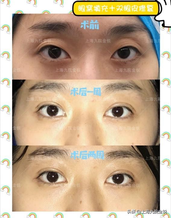 双眼皮VS单眼皮，为什么更多人喜欢双眼皮？